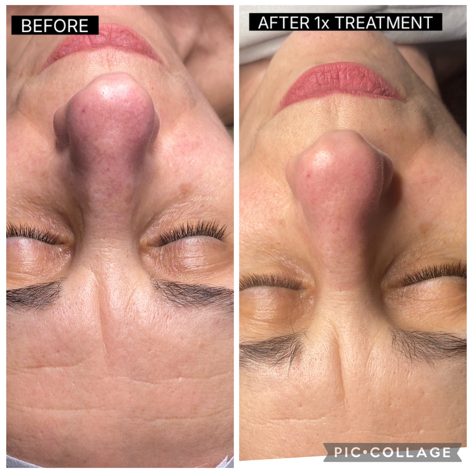 SQT Bio Microneedling before and after result following one treatment