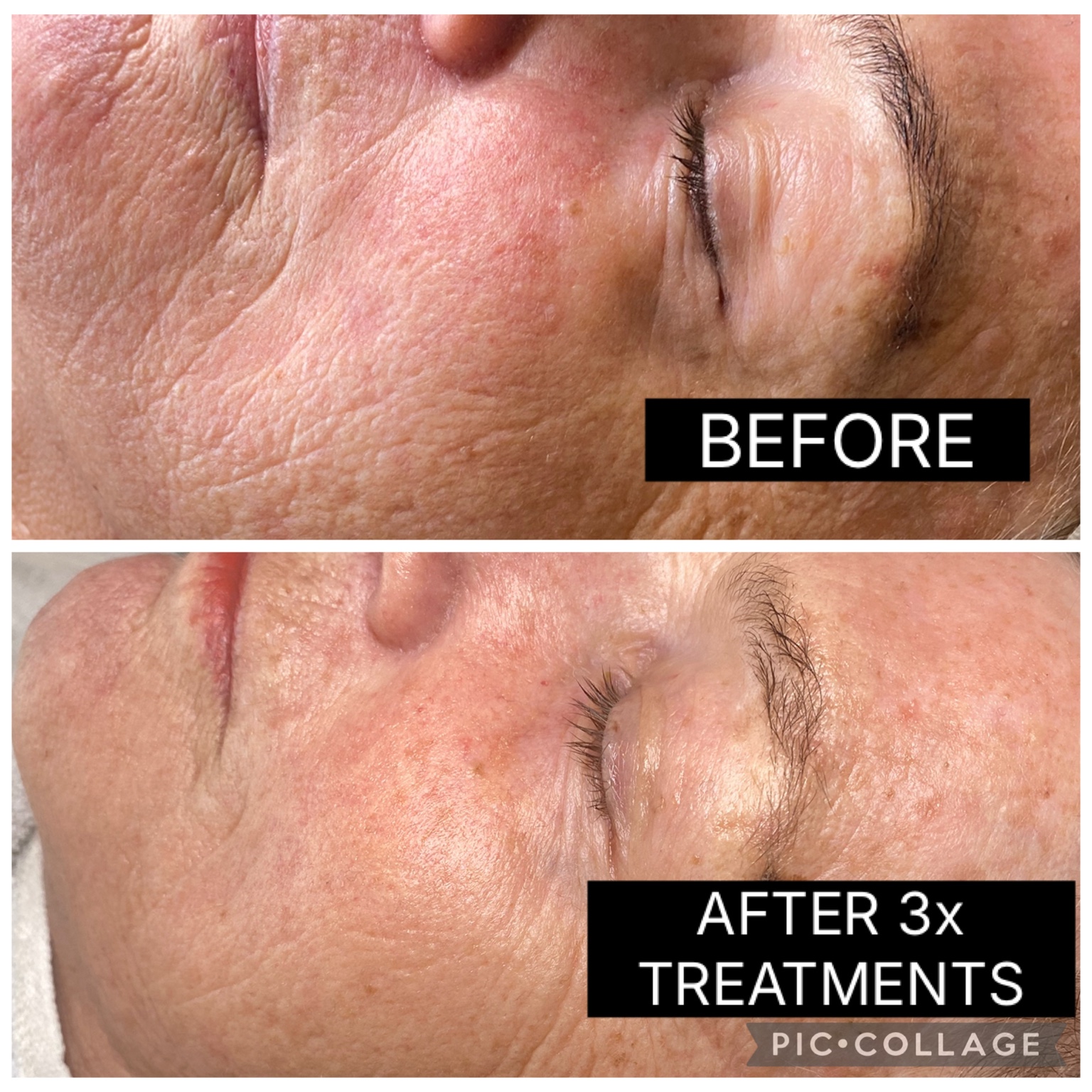 SQT Bio Microneedling before and after result following three treatments