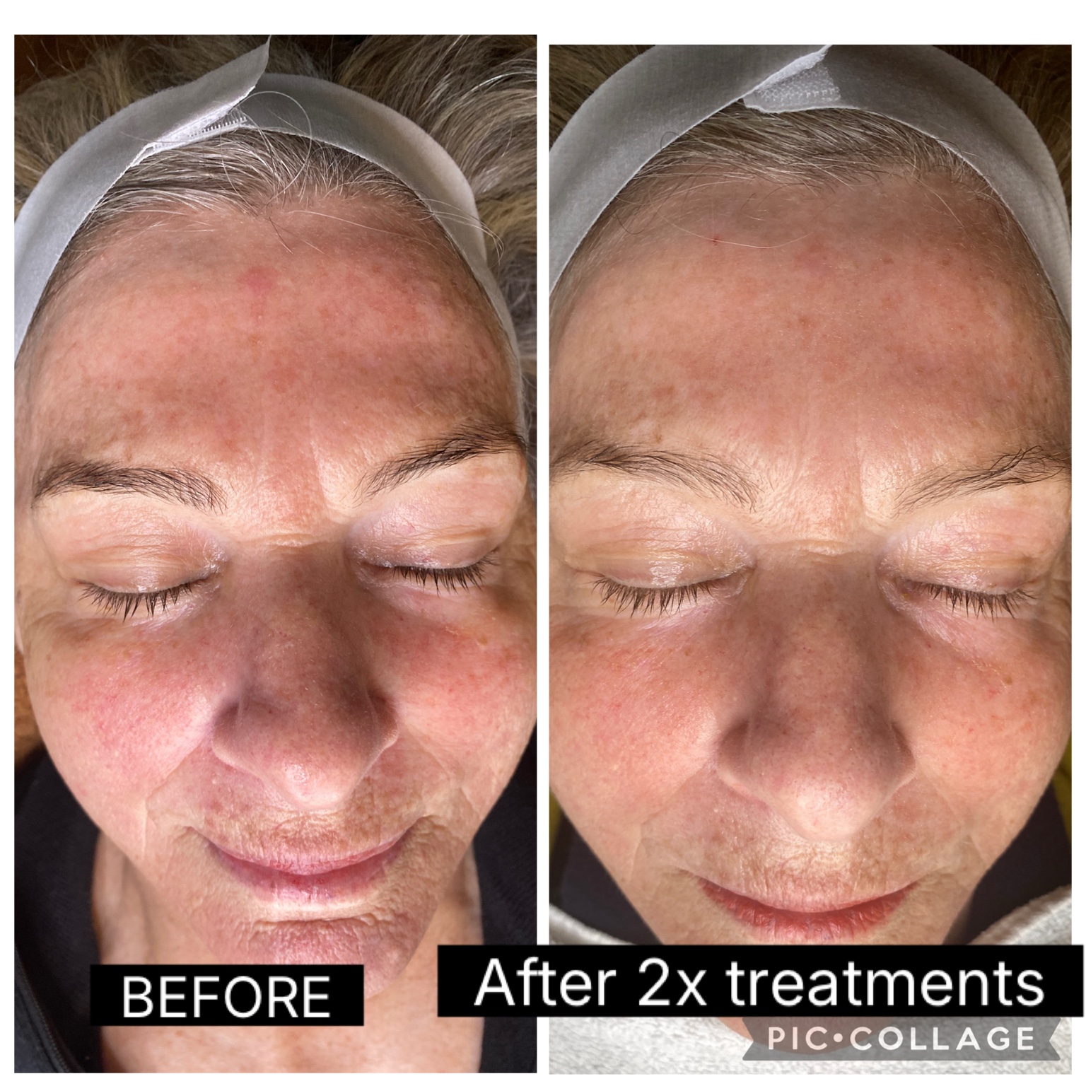 SQT Bio Microneedling before and after result following two treatments