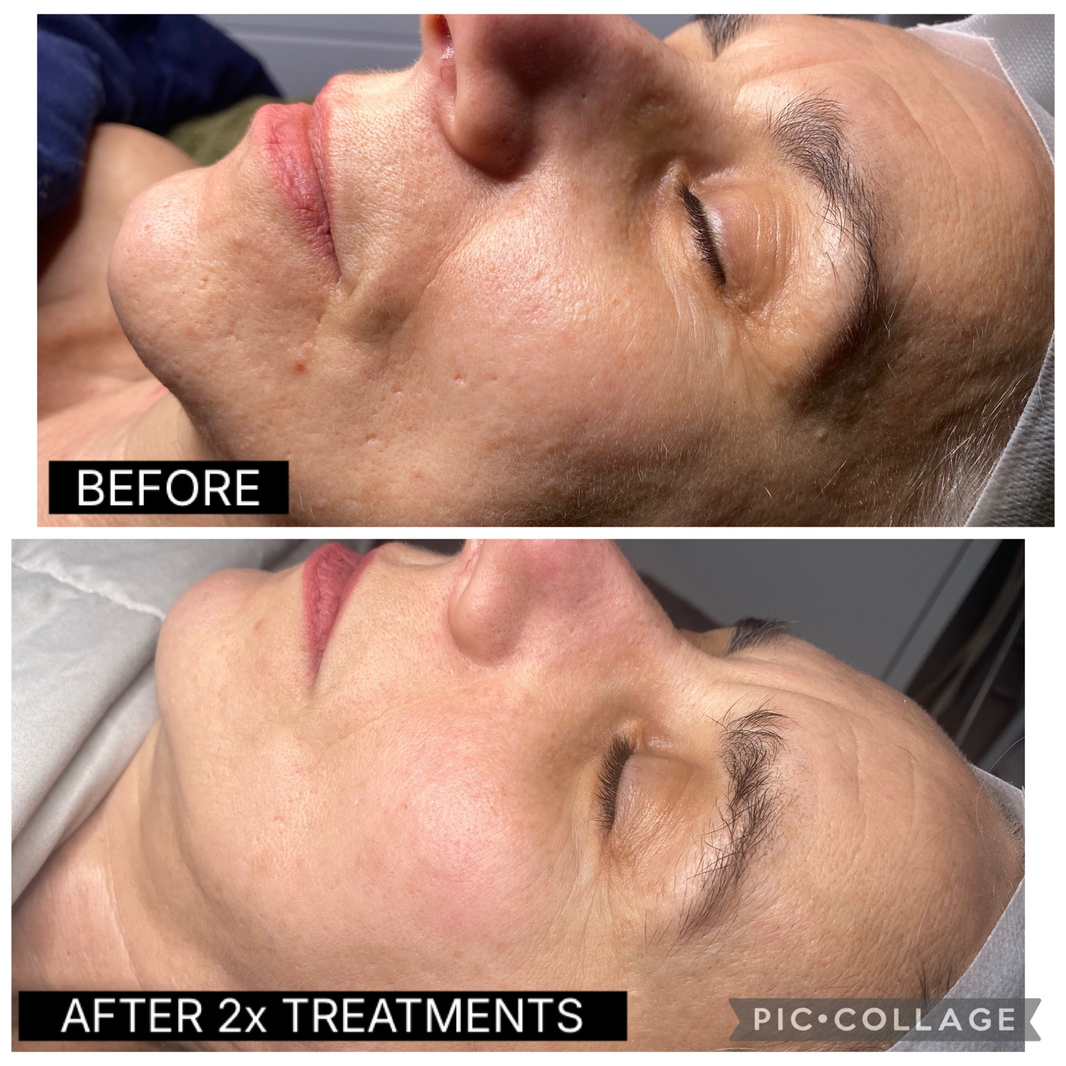 SQT Bio Microneedling before and after facial skin result