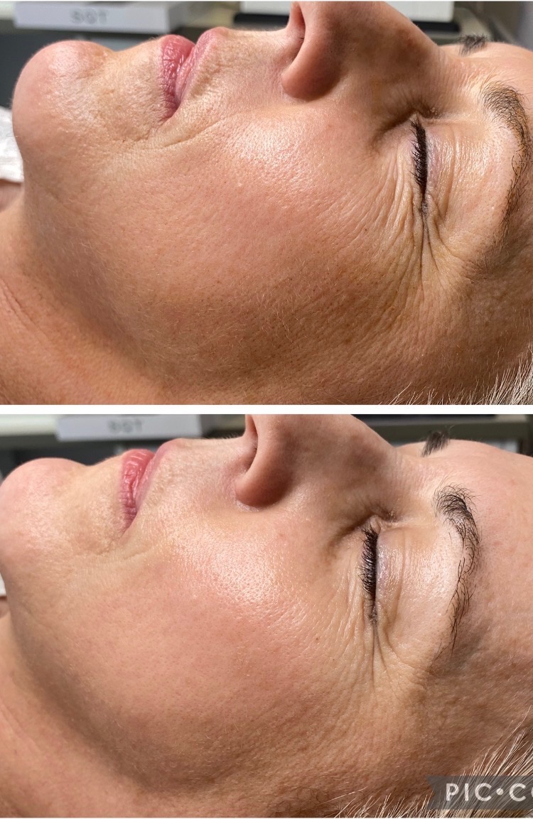 SQT Bio Microneedling before and after skin result